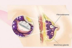 FAM,  Si Tumor Jinak yang Sering Muncul di Payudara Wanita Muda, Bahaya Ta?