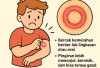 Kurap, Infeksi Jamur Kulit yang Mudah Menular dan Perlu Diwaspadai